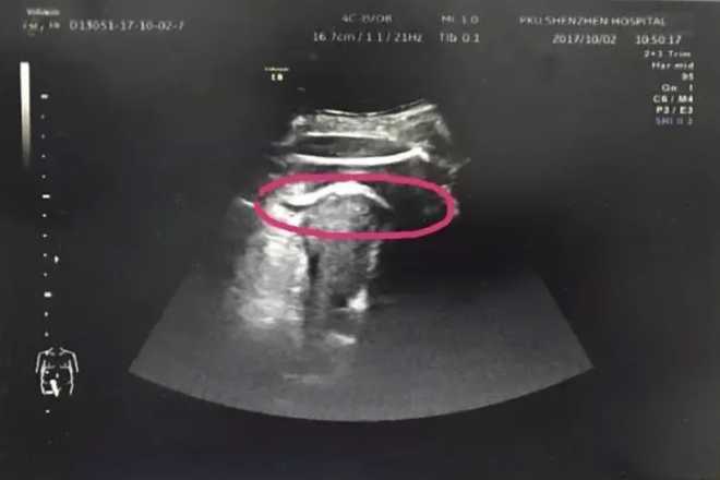 A&#x20;pregnant&#x20;woman&#x20;nearly&#x20;died&#x20;after&#x20;her&#x20;unborn&#x20;baby&#x20;kicked&#x20;a&#x20;hole&#x20;in&#x20;her&#x20;womb