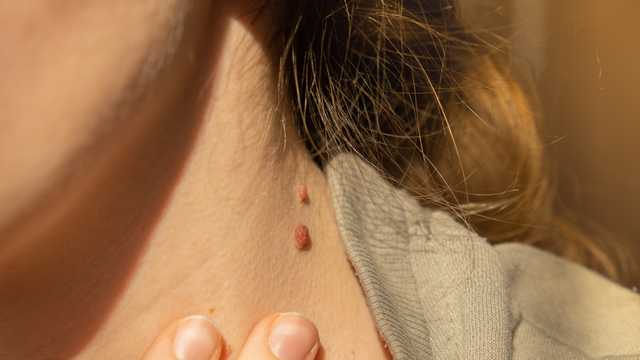 Skin Tag Removal–How to Safely Remove Skin Tags - Vimarsana News