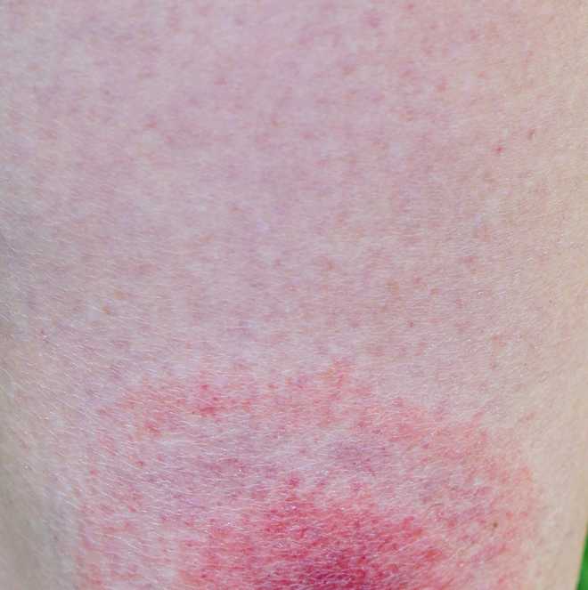 lyme&#x20;disease&#x20;rash