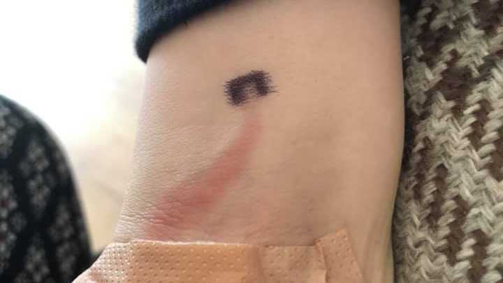 A child's arm with a red streak and a bandage