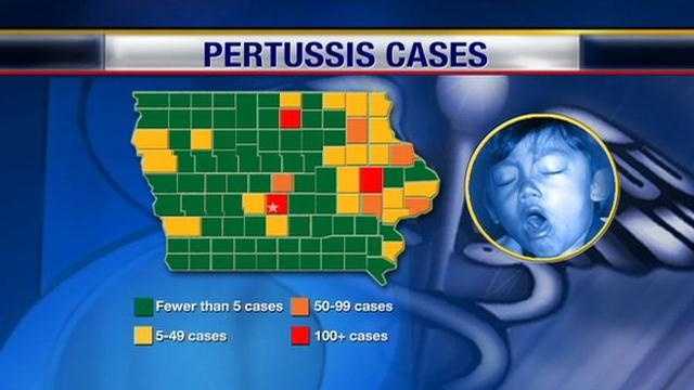 KCCIs Amanda Lewis reports on the whooping cough outbreak in Iowa.
