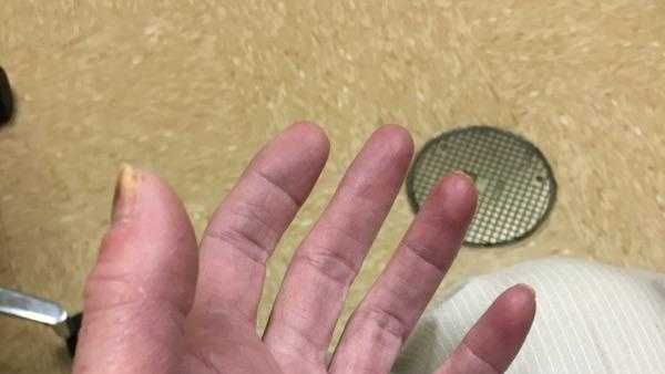 woman-develops-staff-infection-after-getting-her-nails-done