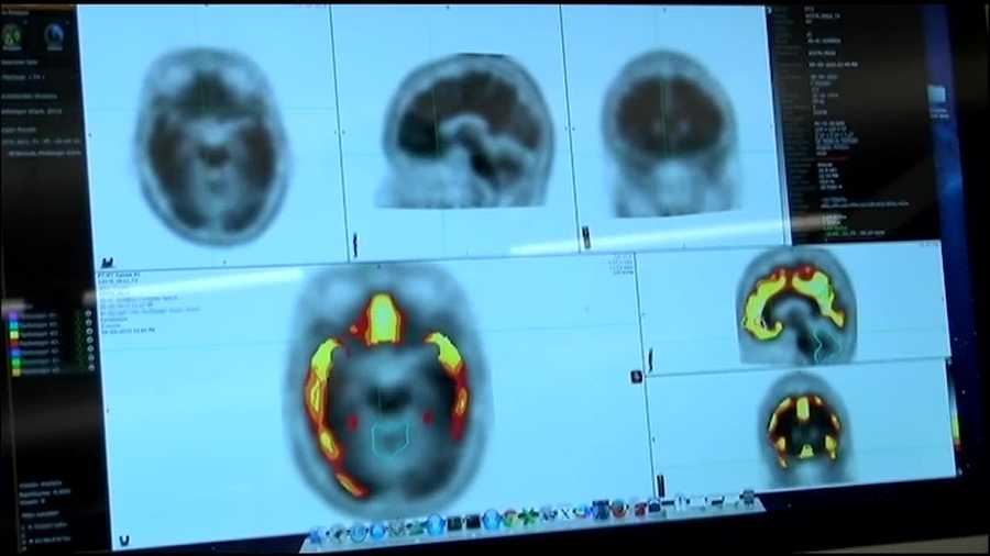 An Alzheimer's study in the Kansas City metro is looking into a new treatment.