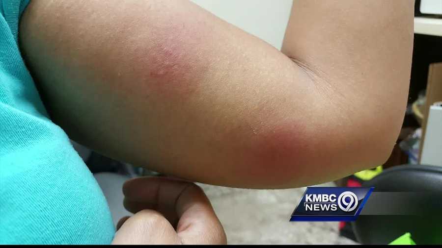 A student at the University of Missouri-Kansas City has been back to class for a week, but she has not been staying in her university apartment because she said it was full of bedbugs.