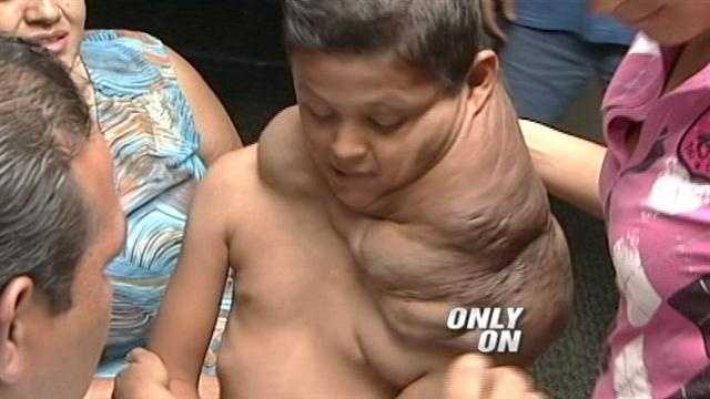 A massive growth has taken over the left side of a 9-year-old boy's body.