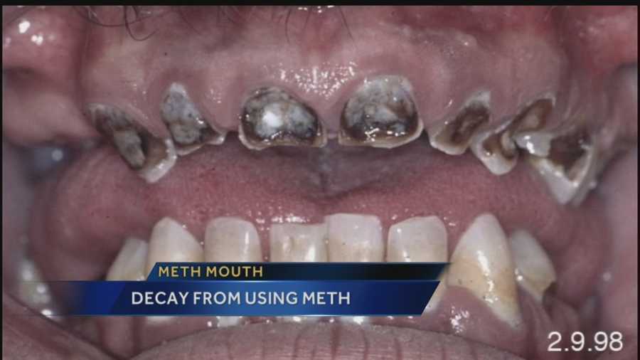 Meth Mouth: Decay From Using Meth