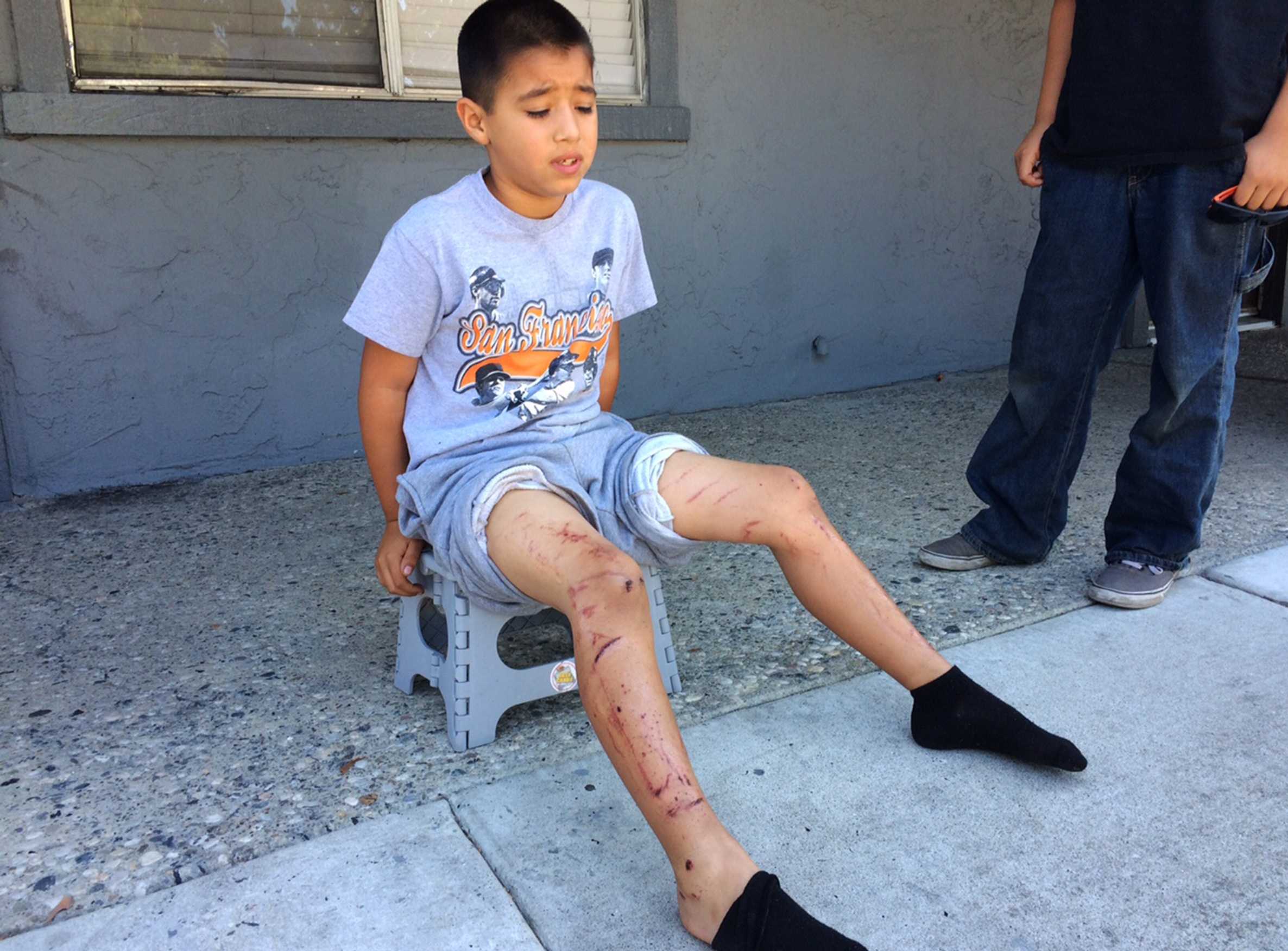 Hollister boy 9 burned by fireworks at block party