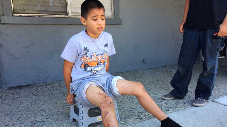 Dakota Ortez was burned in an illegal firework accident at a Hollister block party on the 4th of July. 