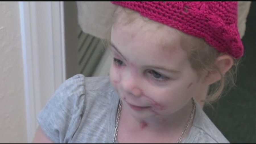 A three-year-old girl, who lost her right eye in a vicious dog attack, now has a new prosthetic eye.