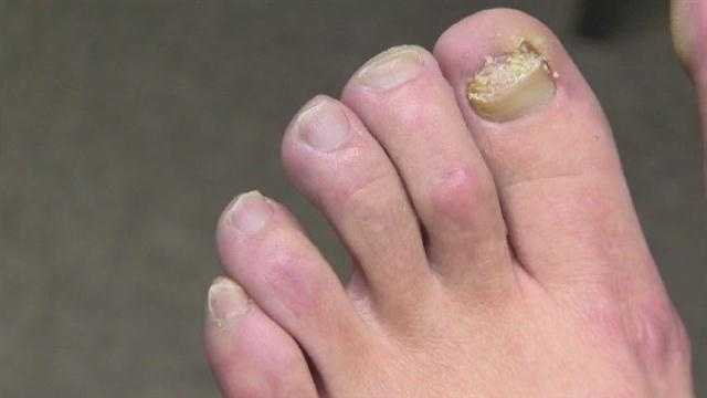 severe toenail fungus