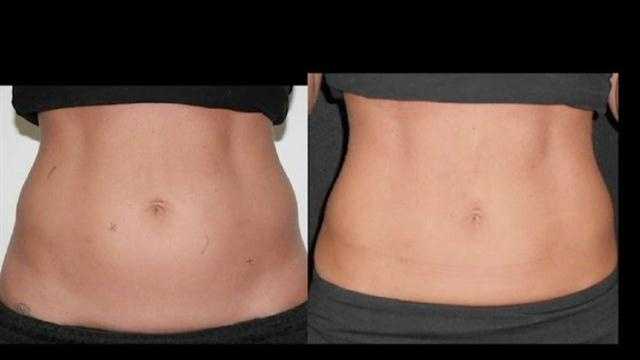 Coolsculpting before and after image.
