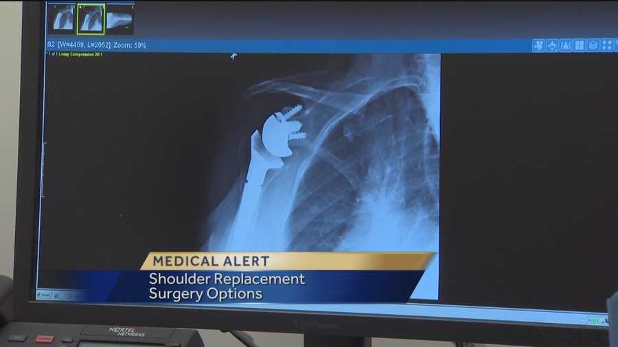 Shoulder replacement surgery - Mayo Clinic