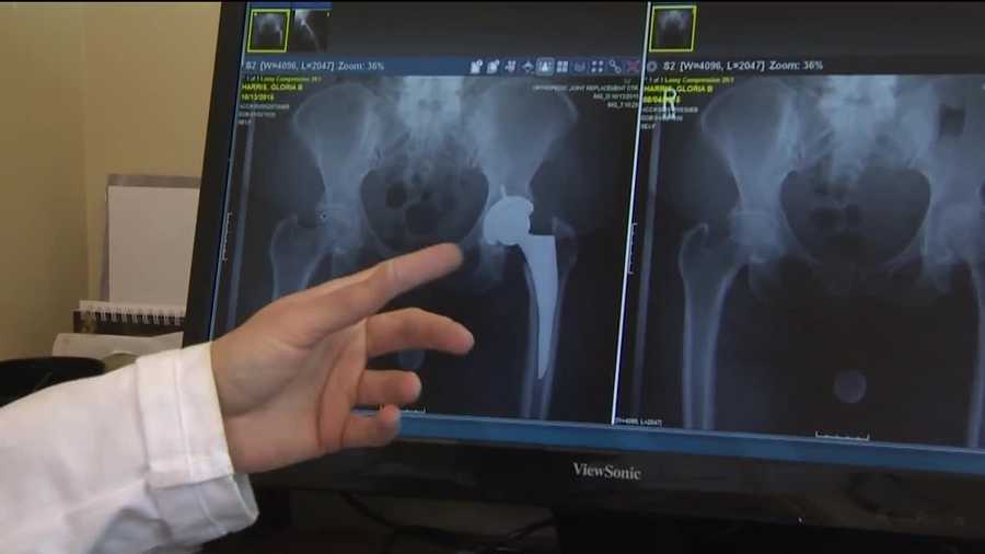 If you have experienced hip pain, chances are you have probably told yourself it is just part of getting older. It can happen to women of all ages, but you shouldn't walk around in pain. Doctors say there are many options available. Mercy Medical Center orthopedic surgeon Kamala Littleton says hip replacement surgery usually comes after they've tried other options.