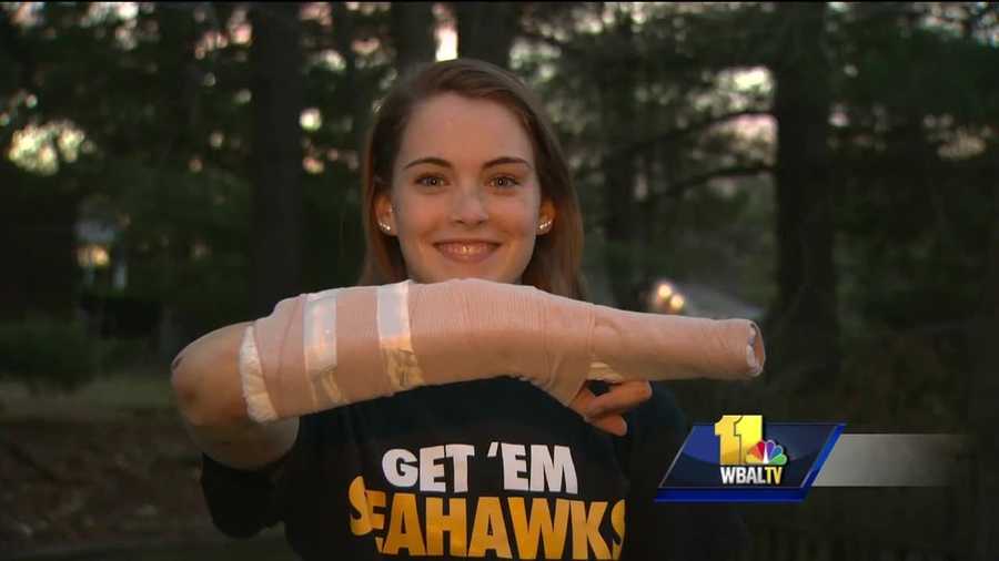 A Harford County woman is nursing several injuries after she fell off a mountain earlier this week. Not many people can say they've fallen off a mountain and lived to tell the story. Rebecca Ashman has a long list of scrapes, bumps, bruises and fractures, but that's not all.