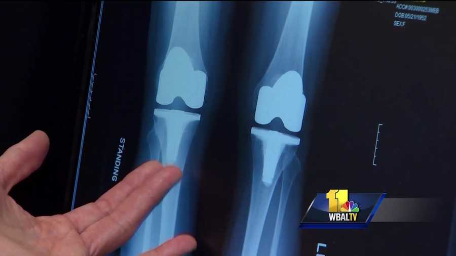 Knee replacement surgery is becoming more common in the U.S. Doctors perform more than 700,000 procedures a year. Now some patients are opting to have both knees done in back-to-back procedures. That includes Anita Andersson, who 10 months ago could not walk in high heels with ease or play tennis. She had both of her knees replaced last November, one right after the other.