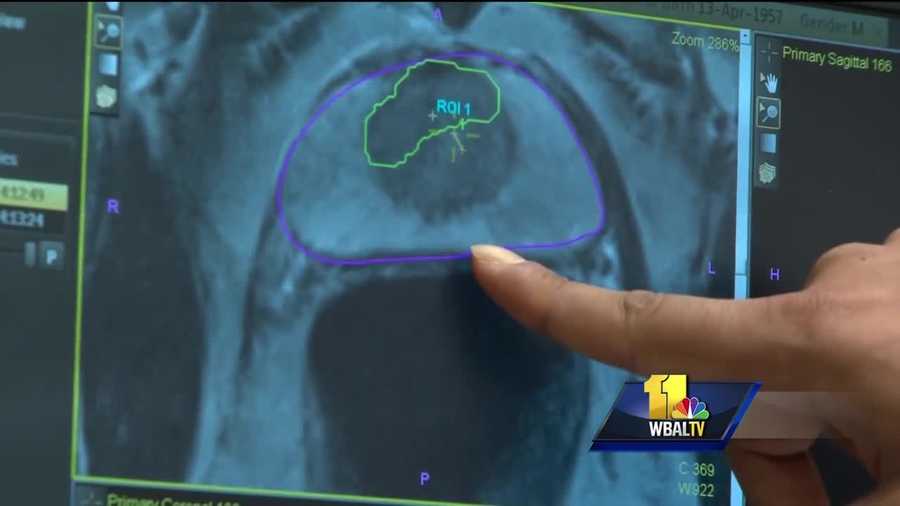 Doctors at the University of Maryland Medical Center are using a new biopsy to better diagnose the severity of prostate cancer. It uses MRI and 3-D technology.
