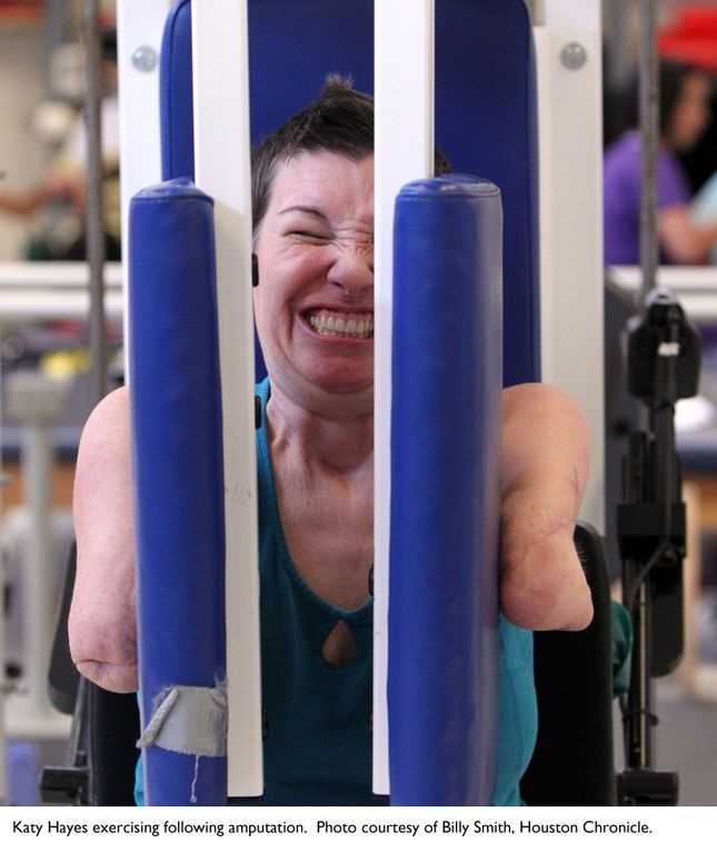 Arm transplant patient ready for procedure