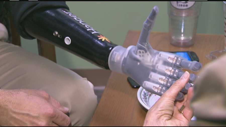 It is sleek and soft and has the strong grip of a human hand. It is the I-Limb ultra revolution and Mike Benning, 48, of Scituate was fitted with it in April.