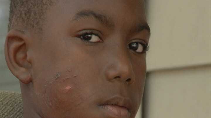 Ka'Nard Allen shows his wound in which a bullet grazed his cheek when shots rang out during a second line parade on Mother's Day in the Seventh Ward.