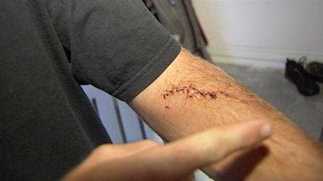 Surfer Gets 14 Stitches After Shark Bite