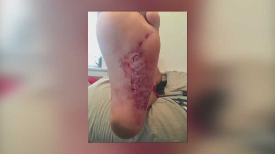 The fifth shark bite victim this year in Volusia County opens up about an attack in the water. Claire Metz (@clairemetzwesh) has the story.