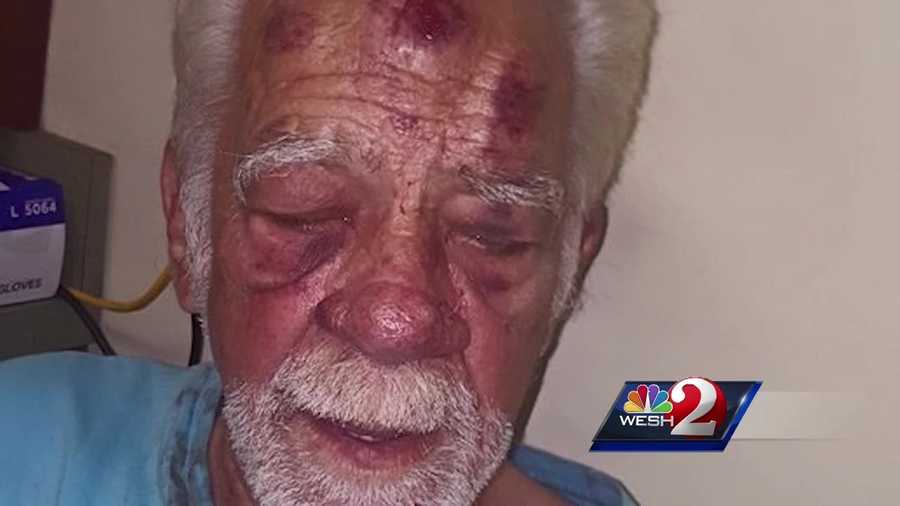 An Orange County man says he was beaten bloody by two women who were after his prescription drugs.