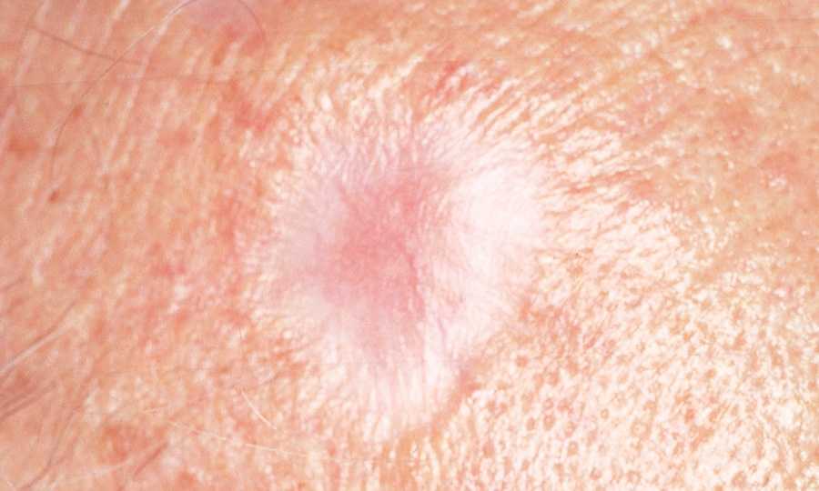 Skin Cancer What You Need To Know