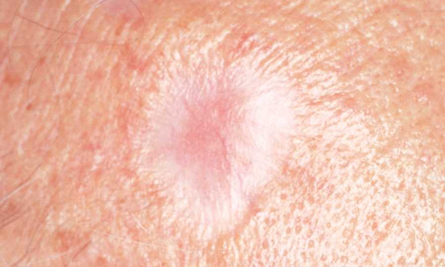 skin-cancer-white-spots-on-arms