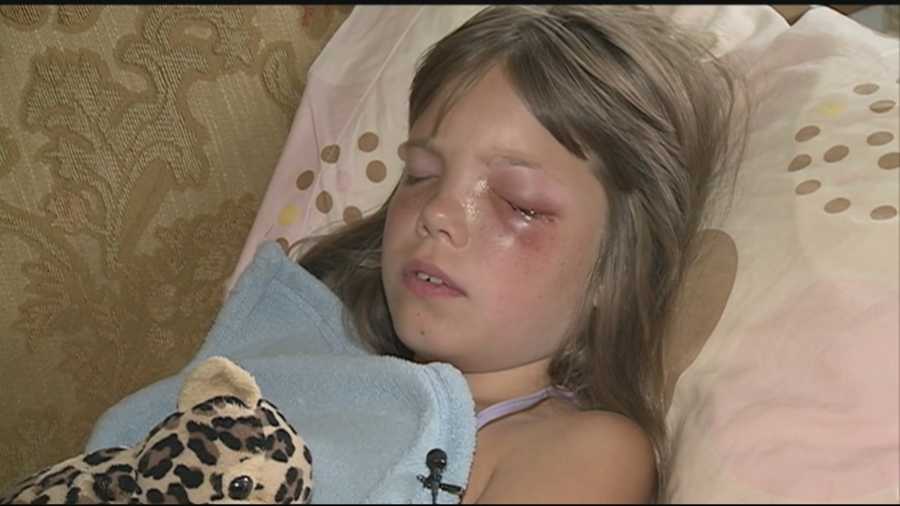 A 9-year-old New Ipswich girl is recovering after undergoing surgery to remove a BB from her eye.