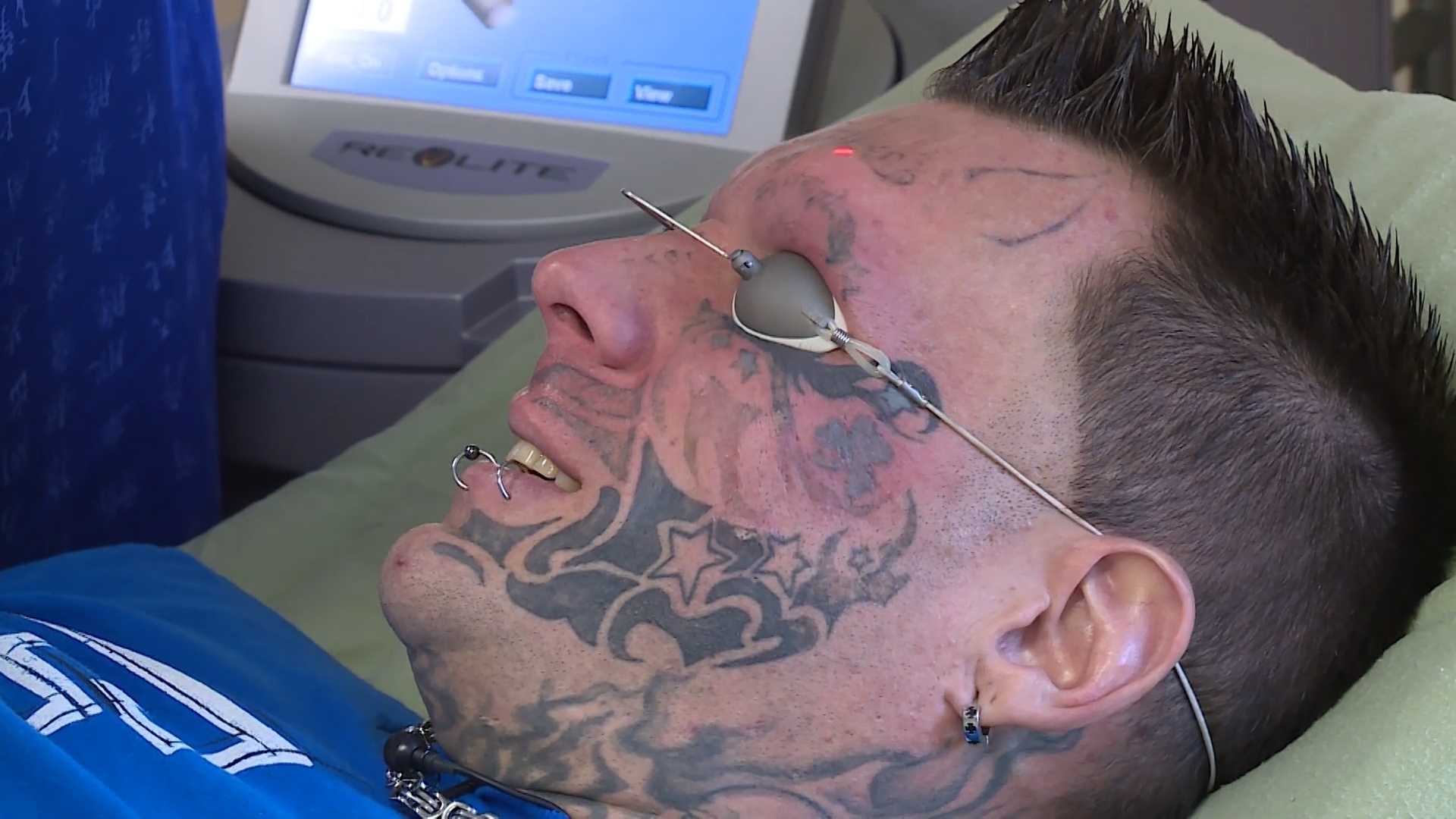 Face Tattoo Removal Services | Removery