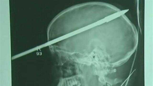 This X-ray shows a spear that pierced a Miami teen's brain.