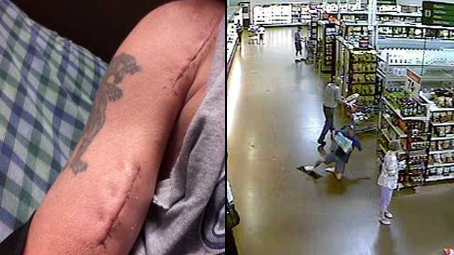 Tom Papakalodoukas suffers from what's called a "popeye deformity" after he fell in a Walmart in Port St. Lucie in 2011. He won a $1.3 million settlement as a result.