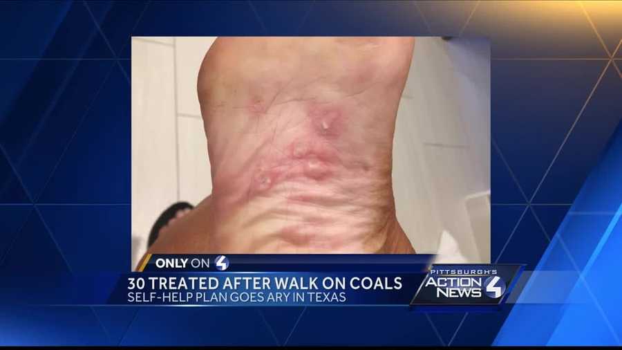 Local woman injured while walking on hot coals at Tony Robbins' Dallas ...