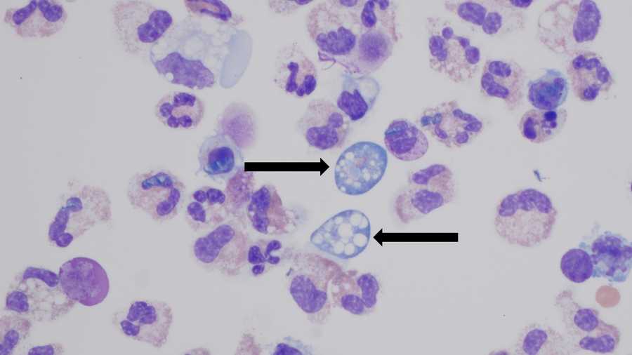 "Brain-eating" amoeba