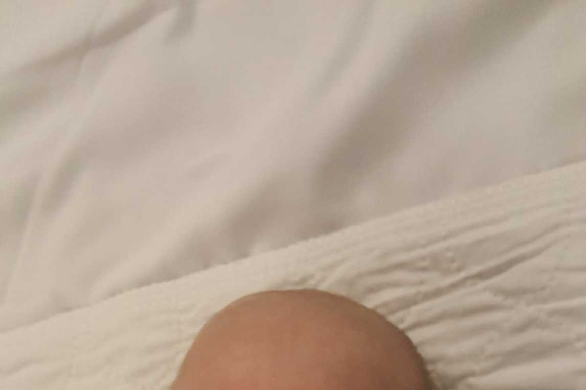 dwarfism newborn