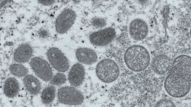 Johnson County man becomes Kansas' first presumptive positive monkeypox case - Vimarsana News