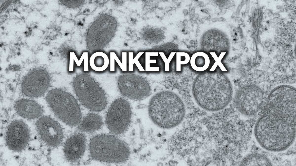 马里兰州发现推定的人类猴痘病毒感染