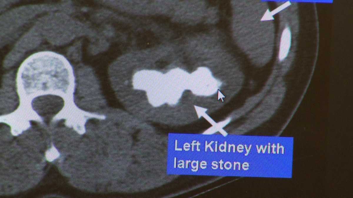 Kidney Stones During Pregnancy Can Be Prevented