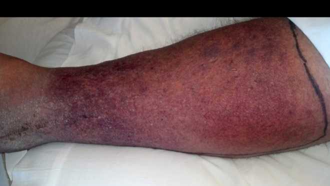 Lon Warrenfeltz's leg, a few days after his Vibrio Vulnificus infection.﻿