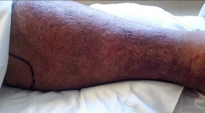 Another image of the dark discoloration on Warrenfeltz's leg following his infection of Vibrio Vulnificus.