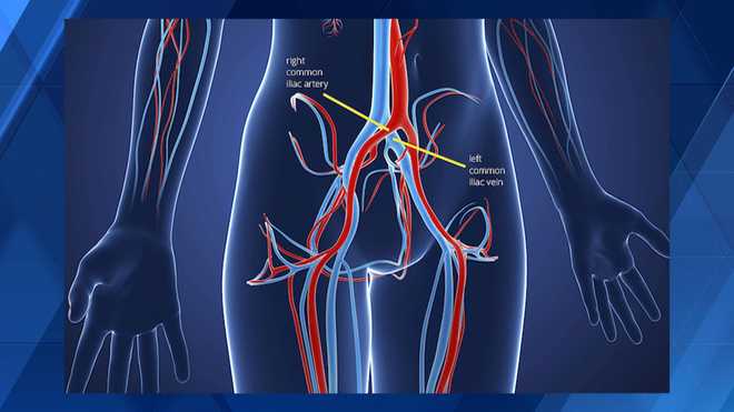 Mindy Basara shares life-changing diagnosis, treatment of May-Thurner