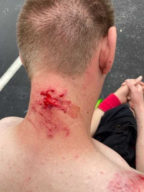 The back of the young man's neck, as captured by his parents following the incident 3 years ago.