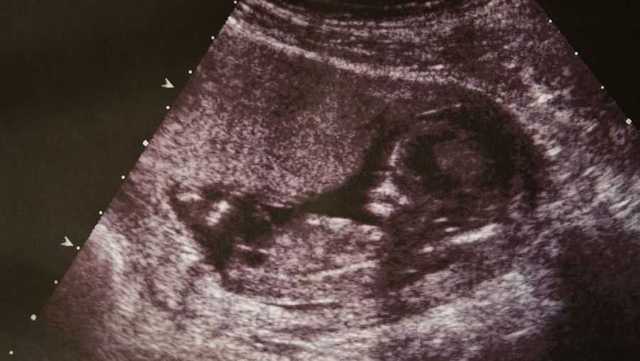 Kentucky Senate passes bill banning abortions after 15 weeks of pregnancy - Vimarsana News