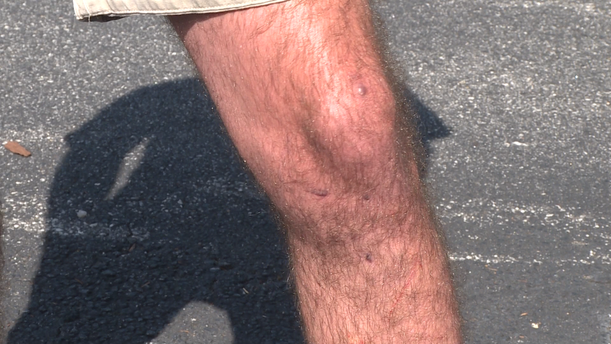 Upstate Doctor S New Acl Surgical Technique Promises Less Pain Quicker Recovery