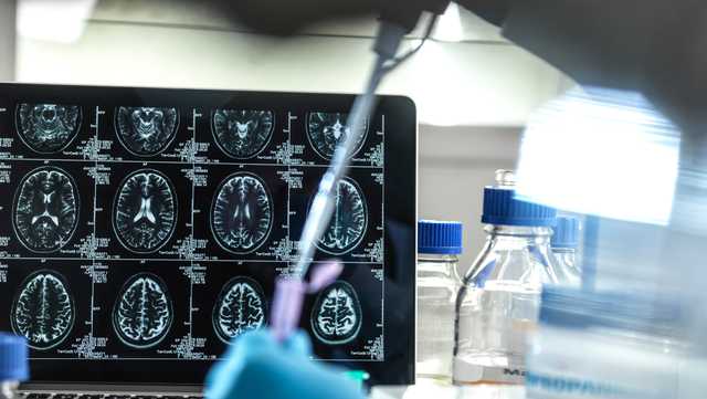 Experimental drug appears to slow progression of Alzheimer's disease. Here's what to know - Vimarsana News