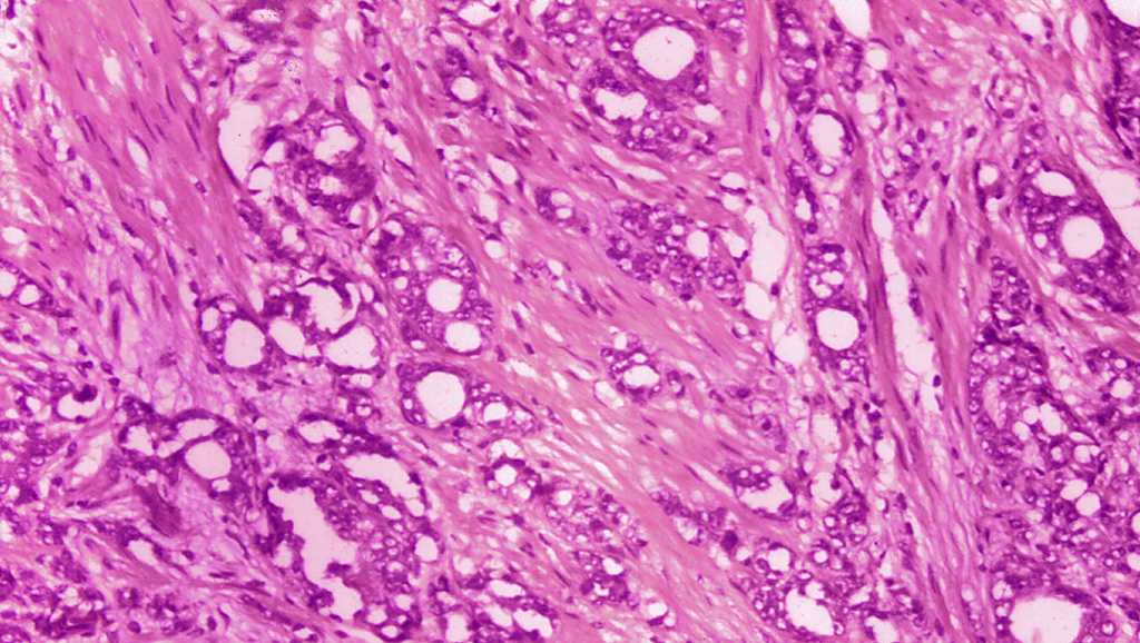 Prostate cancer treatment can wait for most men, study finds - Vimarsana News