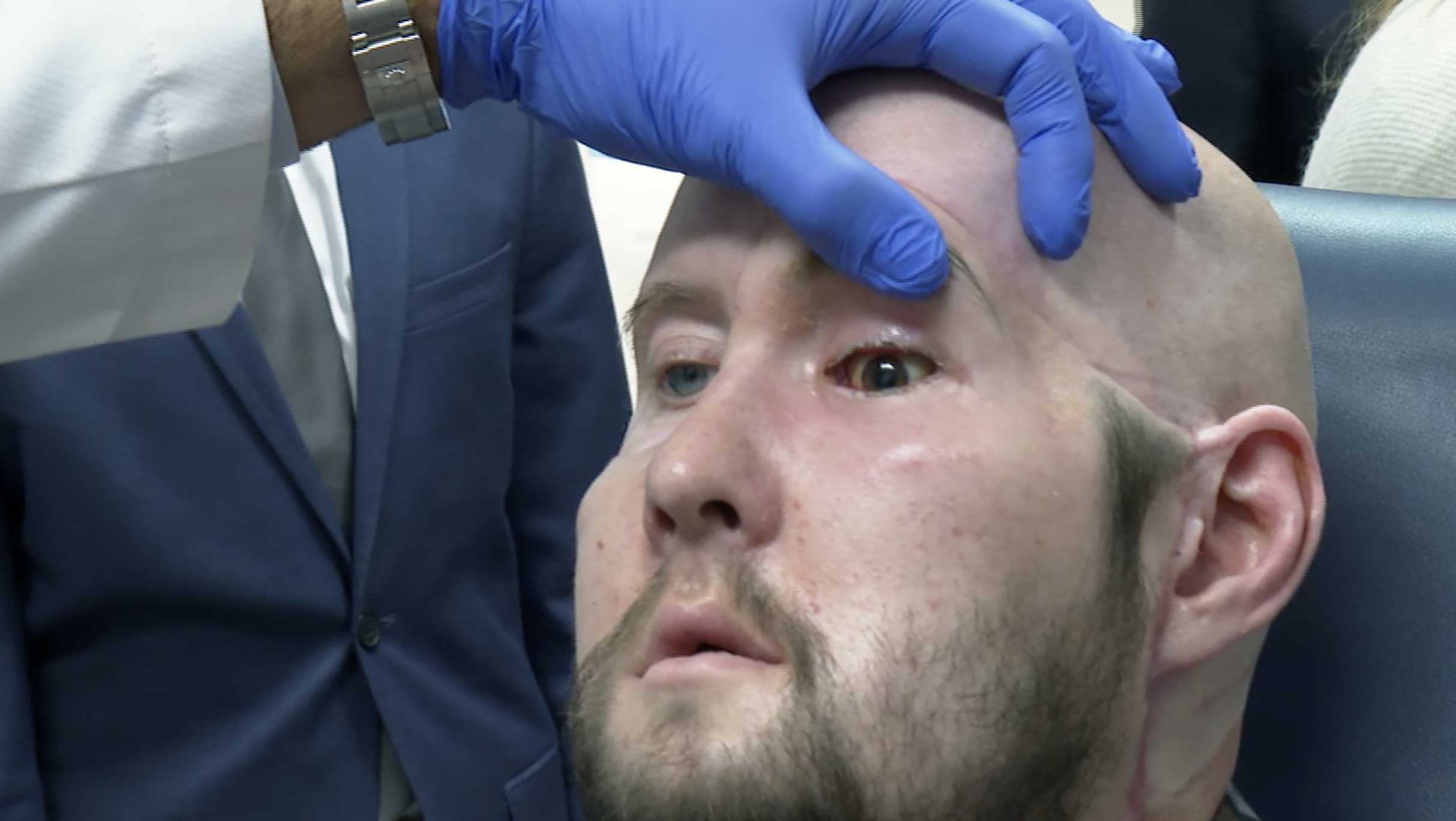 World's first transplant of entire human eye completed in NY - Vimarsana News