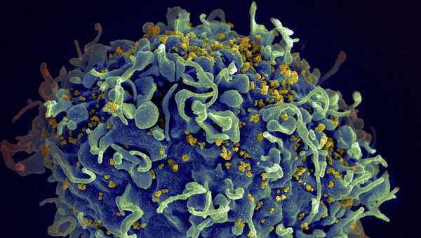 FILE - This electron microscope image made available by the U.S. National Institutes of Health shows a human T cell, in blue, under attack by HIV, in yellow, the virus that causes AIDS. Three women who were diagnosed with HIV after getting 