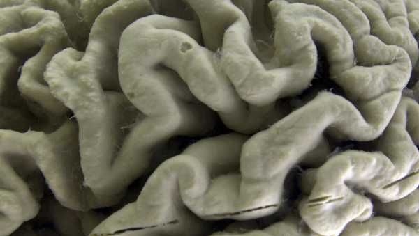 FILE - A section of a human brain with Alzheimer's disease is displayed at the Museum of Neuroanatomy at the University at Buffalo, in Buffalo, N.Y., Oct. 7, 2003. A long-feared gene appears to do more than raise people's risk of Alzheimer's: Inheriting two copies can cause the mind-robbing disease, according to research published in the journal Nature Medicine on Monday, May 6, 2024. (AP Photo/David Duprey, File)