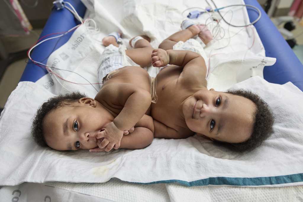 Twin boys celebrate first birthday after life-changing surgery